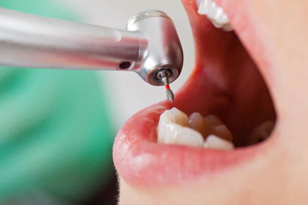 Best Emergency Dental Filling Replacement  in Helena, MT